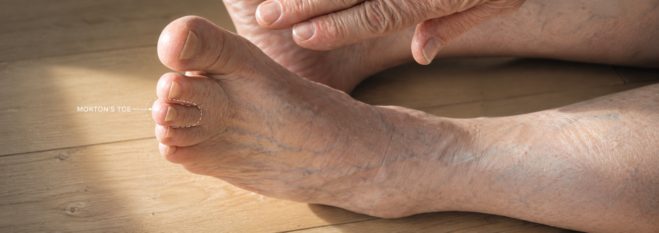 morton's toe​